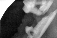 DT_Fx_Mandible